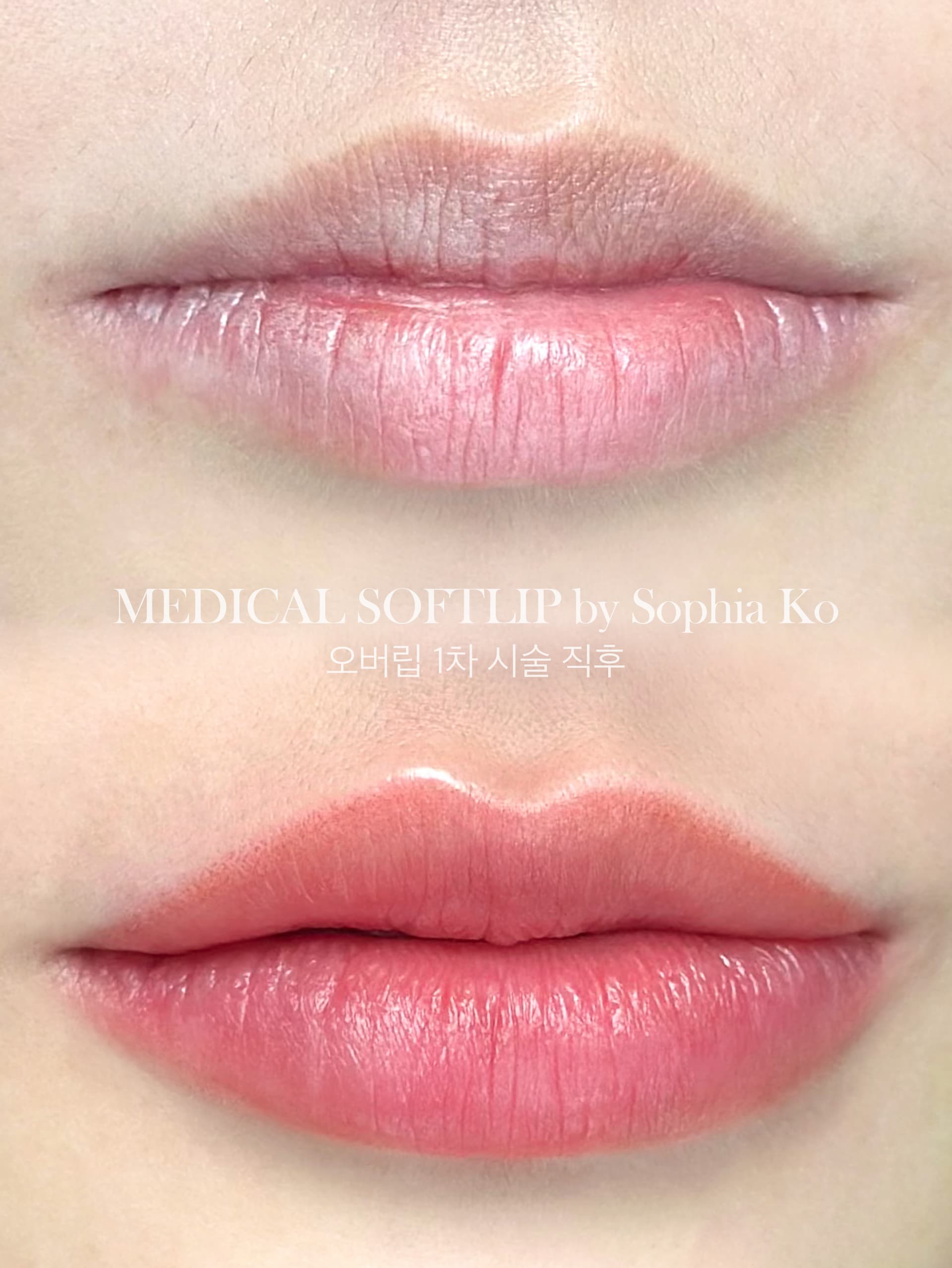 칙칙했던 입술흔을