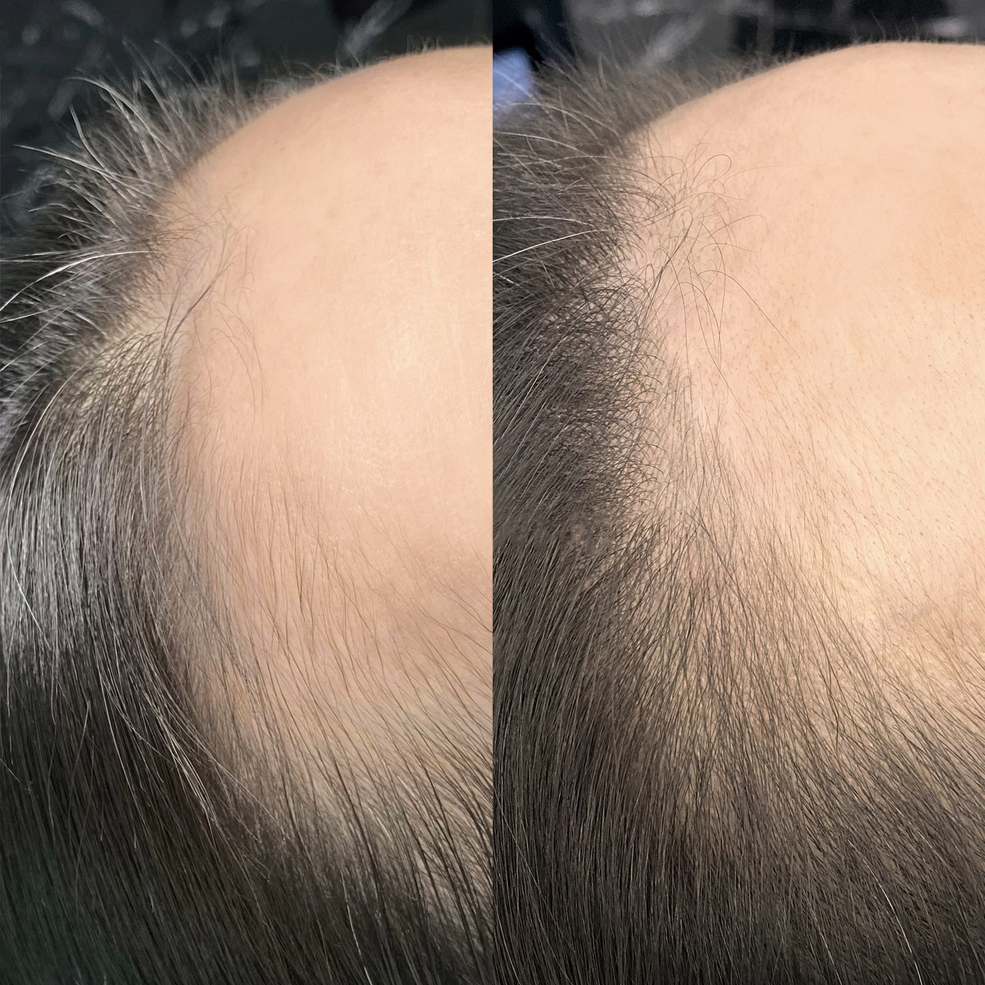 머리 묶을 때마다 신경 쓰이던 빈 라인