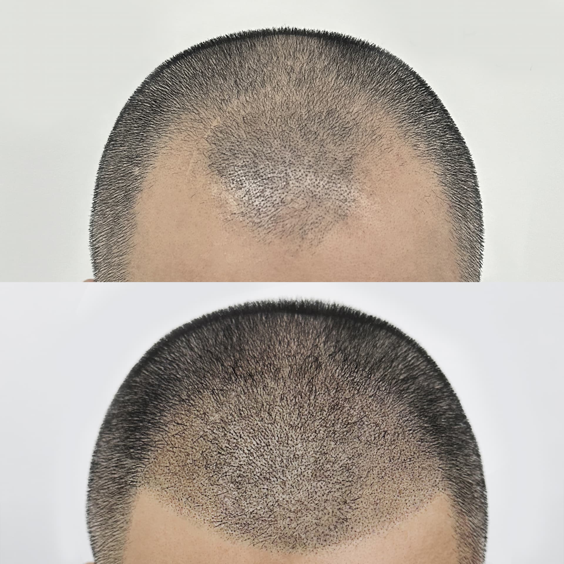 숱 없어 보이던 정수리